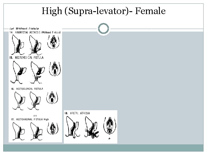 High (Supra-levator)- Female High (Supra-levator)- Female