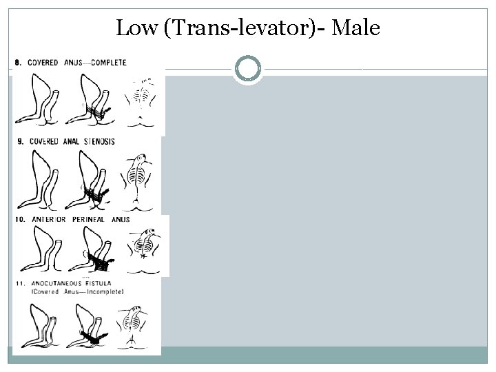 Low (Trans-levator)- Male Low (Trans-levator)- Male
