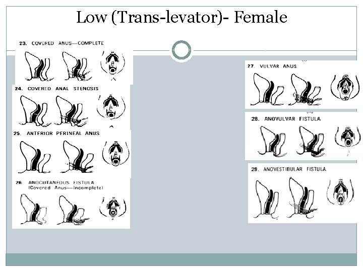 Low (Trans-levator)- Female Low (Trans-levator)- Female