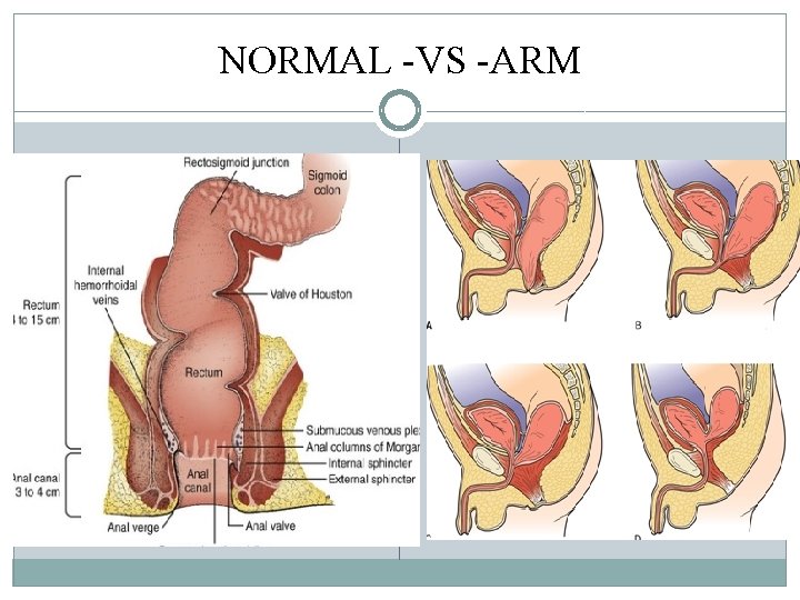 NORMAL -VS -ARM NORMAL -VS -ARM