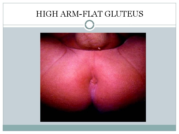 HIGH ARM-FLAT GLUTEUS HIGH ARM-FLAT GLUTEUS