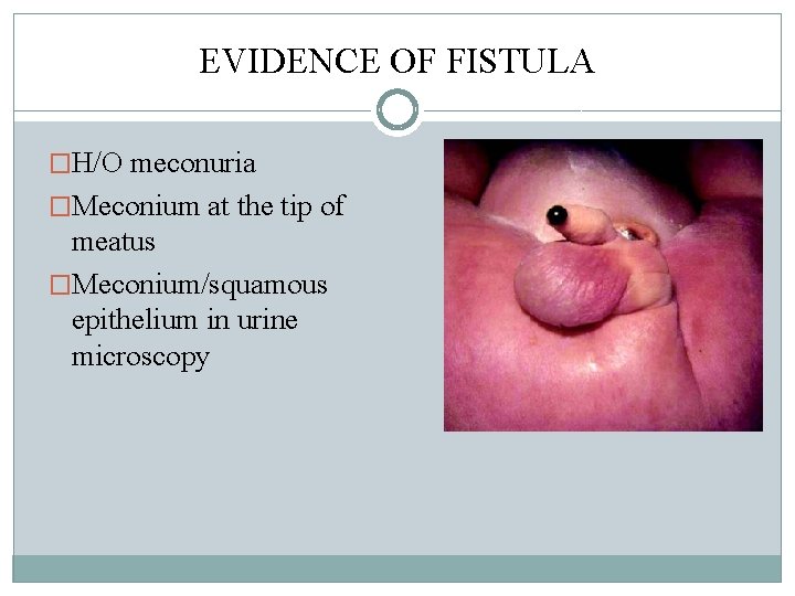 EVIDENCE OF FISTULA �H/O meconuria �Meconium at the tip of meatus �Meconium/squamous epithelium in EVIDENCE OF FISTULA �H/O meconuria �Meconium at the tip of meatus �Meconium/squamous epithelium in