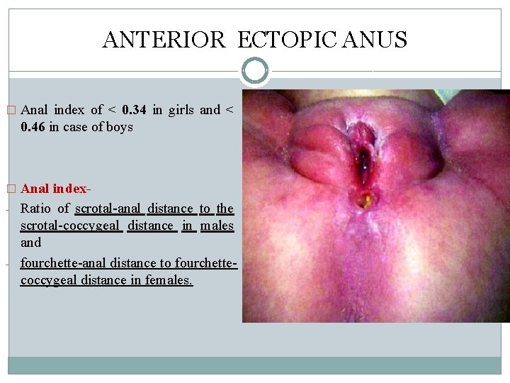 ANTERIOR ECTOPIC ANUS � Anal index of < 0. 34 in girls and < ANTERIOR ECTOPIC ANUS � Anal index of < 0. 34 in girls and <