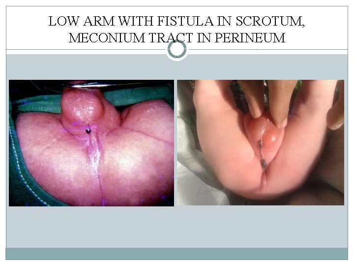 LOW ARM WITH FISTULA IN SCROTUM, MECONIUM TRACT IN PERINEUM LOW ARM WITH FISTULA IN SCROTUM, MECONIUM TRACT IN PERINEUM