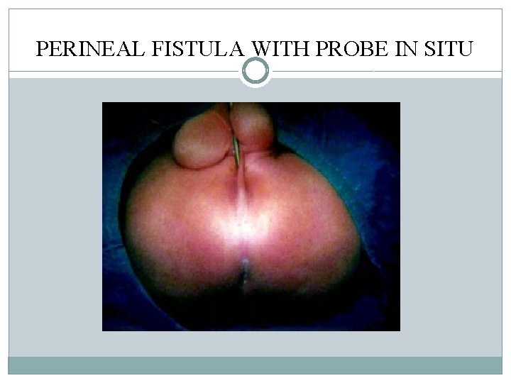 PERINEAL FISTULA WITH PROBE IN SITU PERINEAL FISTULA WITH PROBE IN SITU