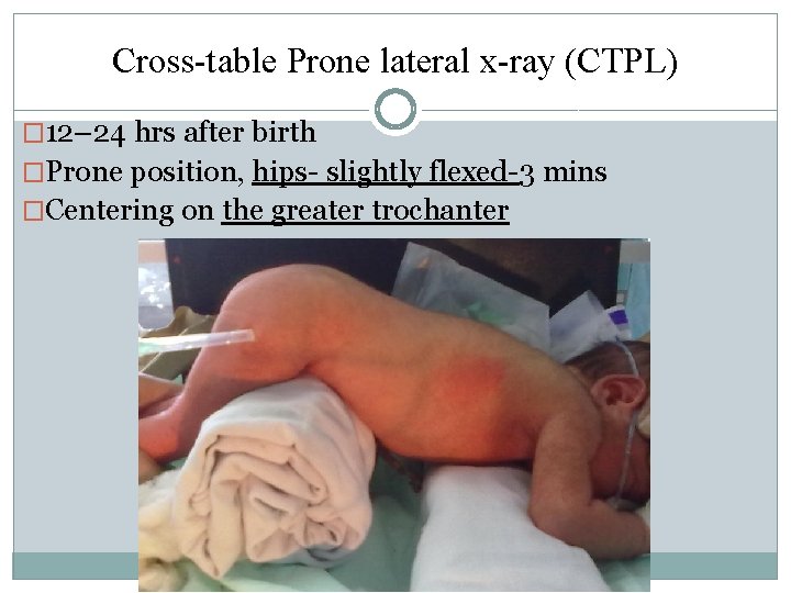 Cross-table Prone lateral x-ray (CTPL) � 12– 24 hrs after birth �Prone position, hips- Cross-table Prone lateral x-ray (CTPL) � 12– 24 hrs after birth �Prone position, hips-