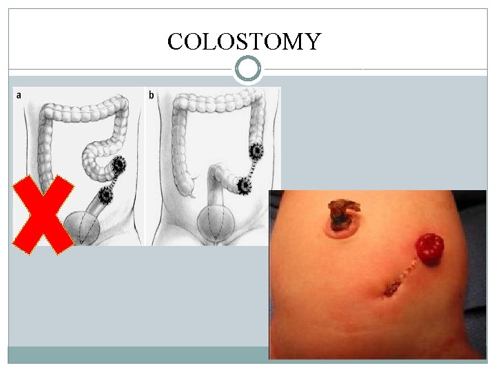 COLOSTOMY COLOSTOMY