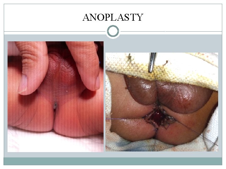 ANOPLASTY ANOPLASTY
