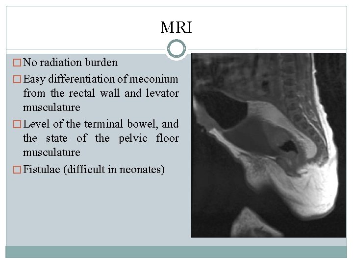 MRI � No radiation burden � Easy differentiation of meconium from the rectal wall MRI � No radiation burden � Easy differentiation of meconium from the rectal wall