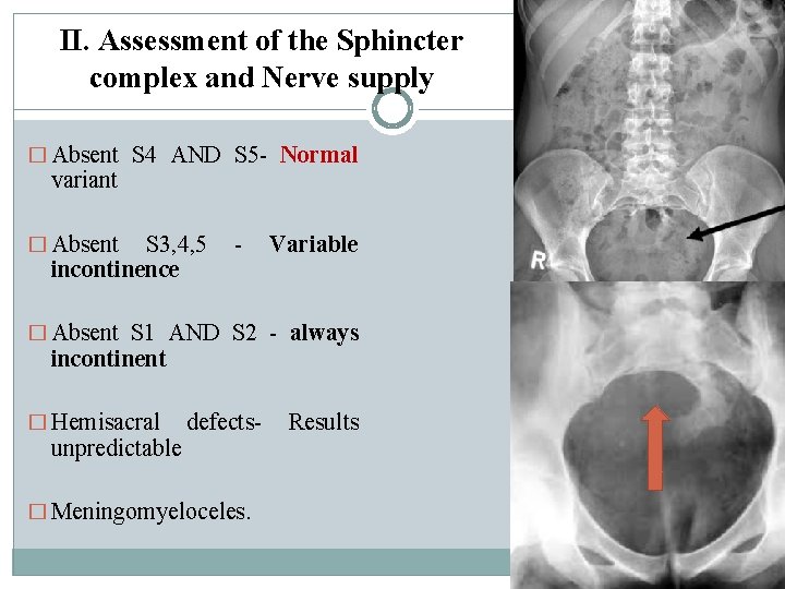 II. Assessment of the Sphincter complex and Nerve supply � Absent S 4 AND II. Assessment of the Sphincter complex and Nerve supply � Absent S 4 AND