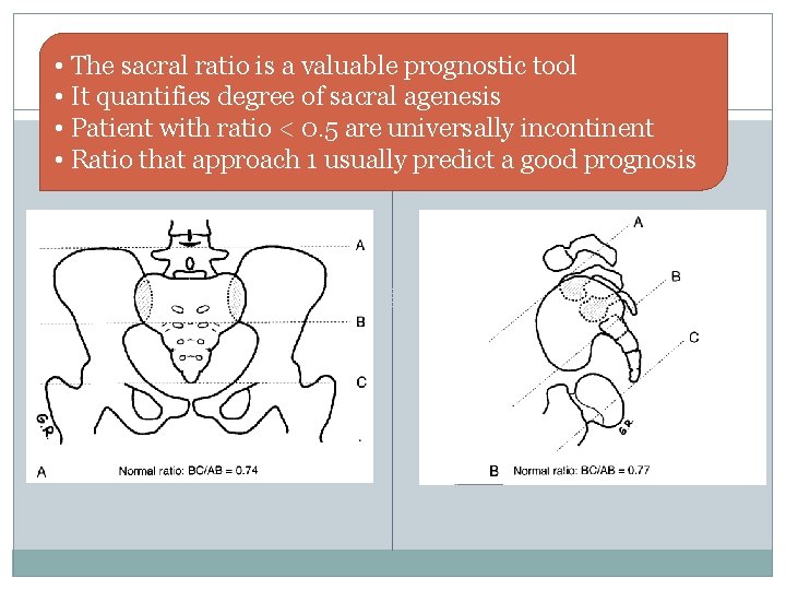 • The sacral ratio is a valuable prognostic tool • It quantifies degree • The sacral ratio is a valuable prognostic tool • It quantifies degree