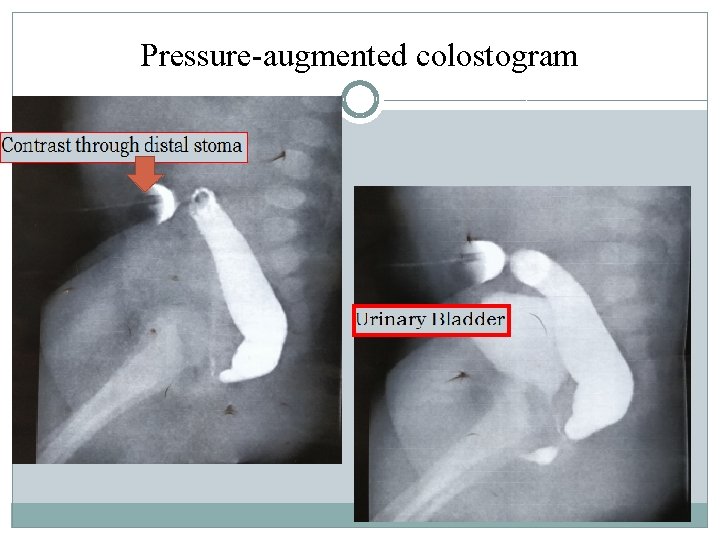 Pressure-augmented colostogram Pressure-augmented colostogram
