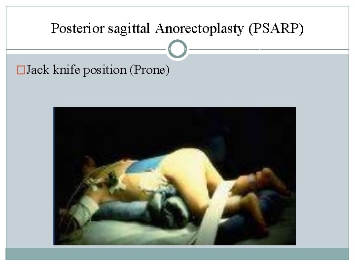 Posterior sagittal Anorectoplasty (PSARP) �Jack knife position (Prone) Posterior sagittal Anorectoplasty (PSARP) �Jack knife position (Prone)