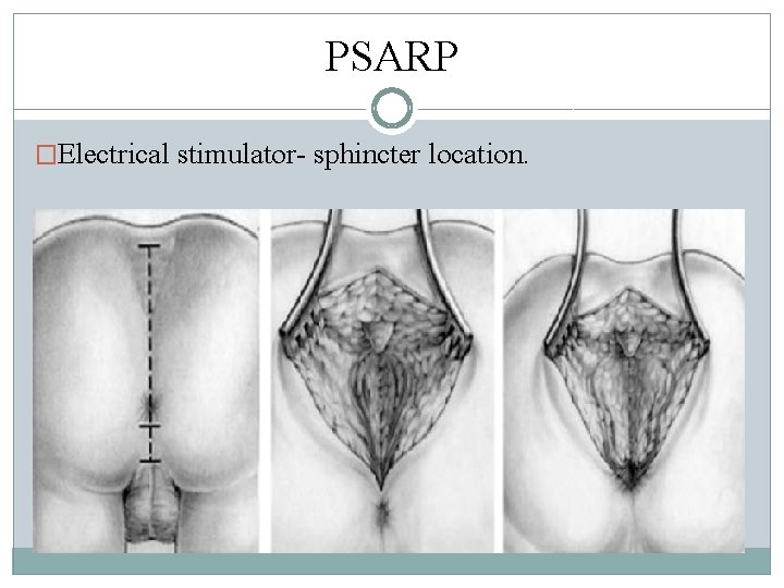 PSARP �Electrical stimulator- sphincter location. PSARP �Electrical stimulator- sphincter location.