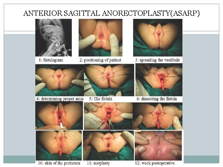 ANTERIOR SAGITTAL ANORECTOPLASTY(ASARP) ANTERIOR SAGITTAL ANORECTOPLASTY(ASARP)
