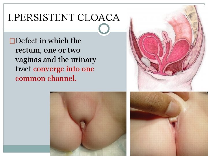 I. PERSISTENT CLOACA �Defect in which the rectum, one or two vaginas and the I. PERSISTENT CLOACA �Defect in which the rectum, one or two vaginas and the