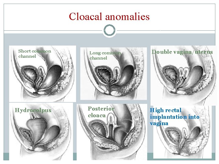 Cloacal anomalies Short common channel Hydrocolpus Long common channel Posterior cloaca Double vagina/uterus High Cloacal anomalies Short common channel Hydrocolpus Long common channel Posterior cloaca Double vagina/uterus High