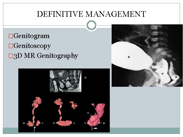 DEFINITIVE MANAGEMENT �Genitogram �Genitoscopy � 3 D MR Genitography DEFINITIVE MANAGEMENT �Genitogram �Genitoscopy � 3 D MR Genitography