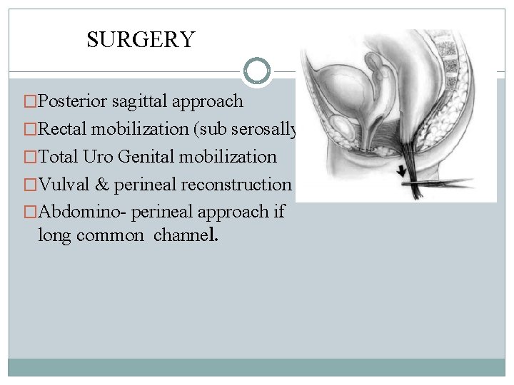 SURGERY �Posterior sagittal approach �Rectal mobilization (sub serosally) �Total Uro Genital mobilization �Vulval & SURGERY �Posterior sagittal approach �Rectal mobilization (sub serosally) �Total Uro Genital mobilization �Vulval &