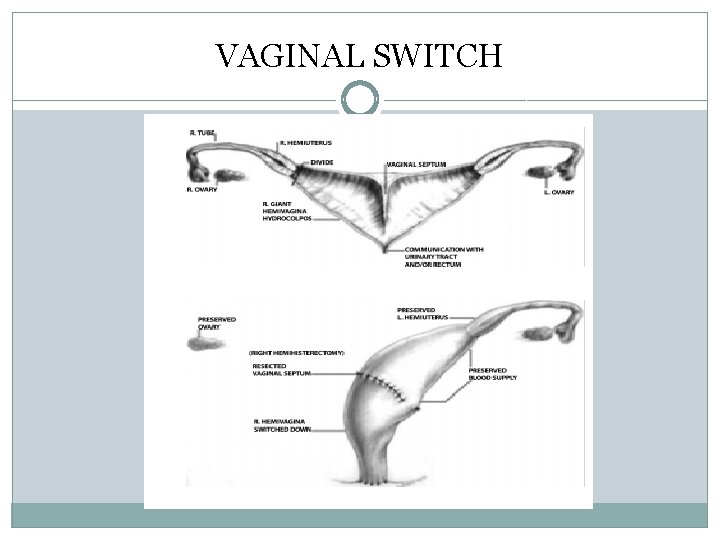 VAGINAL SWITCH VAGINAL SWITCH
