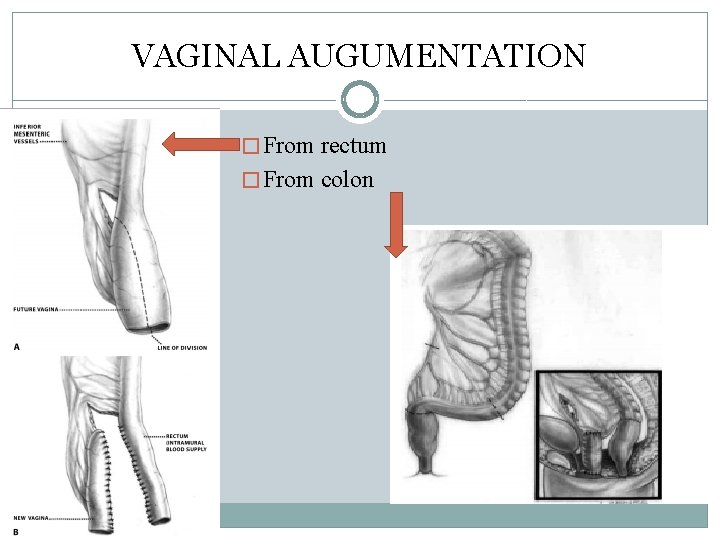 VAGINAL AUGUMENTATION � From rectum � From colon VAGINAL AUGUMENTATION � From rectum � From colon