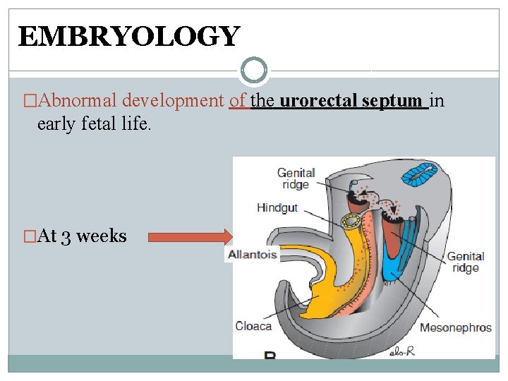 EMBRYOLOGY �Abnormal development of the urorectal septum in early fetal life. �At 3 weeks EMBRYOLOGY �Abnormal development of the urorectal septum in early fetal life. �At 3 weeks