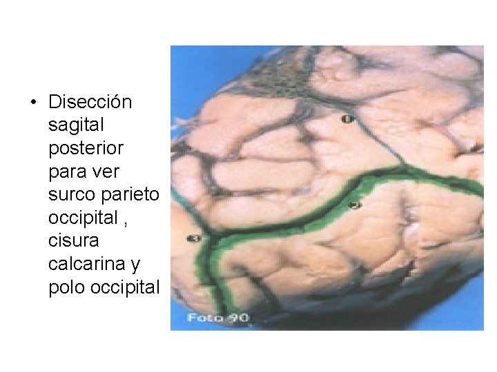  • Disección sagital posterior para ver surco parieto occipital , cisura calcarina y