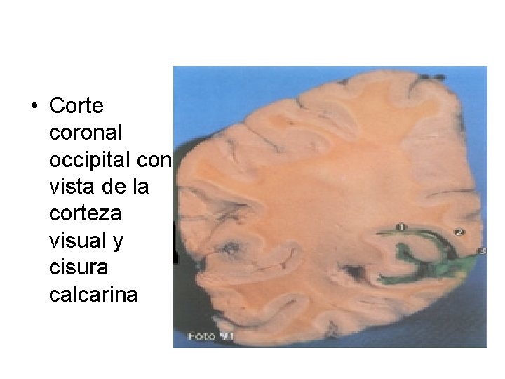  • Corte coronal occipital con vista de la corteza visual y cisura calcarina