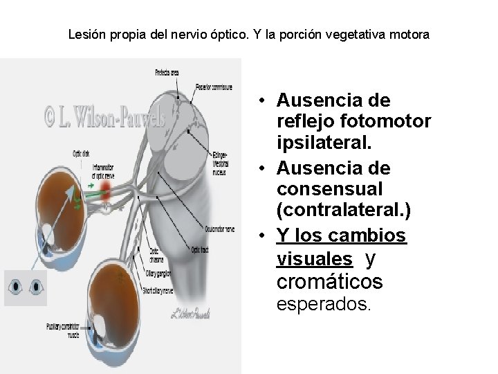 Lesión propia del nervio óptico. Y la porción vegetativa motora • Ausencia de reflejo