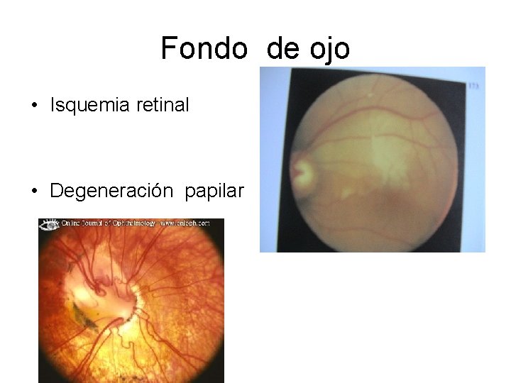 Fondo de ojo • Isquemia retinal • Degeneración papilar 