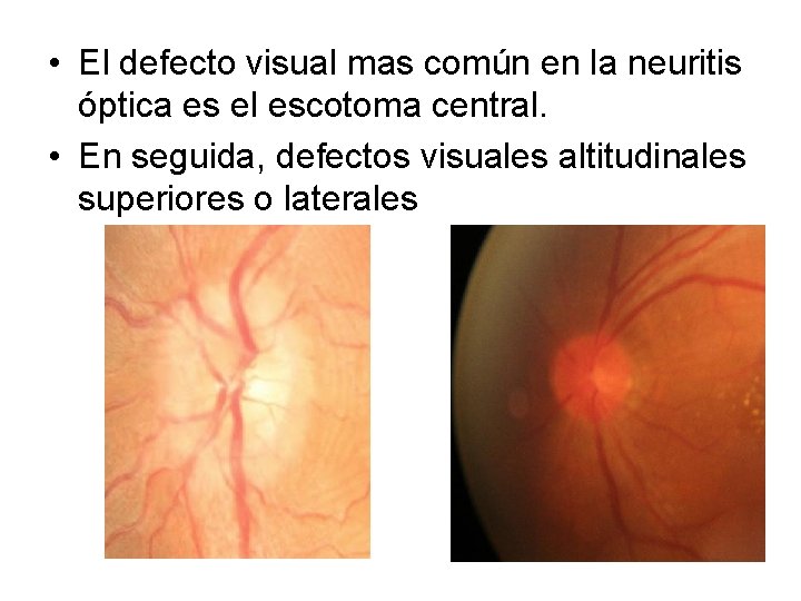  • El defecto visual mas común en la neuritis óptica es el escotoma