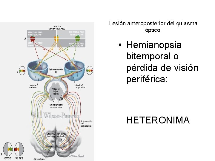 Lesión anteroposterior del quiasma óptico. • Hemianopsia bitemporal o pérdida de visión periférica: HETERONIMA