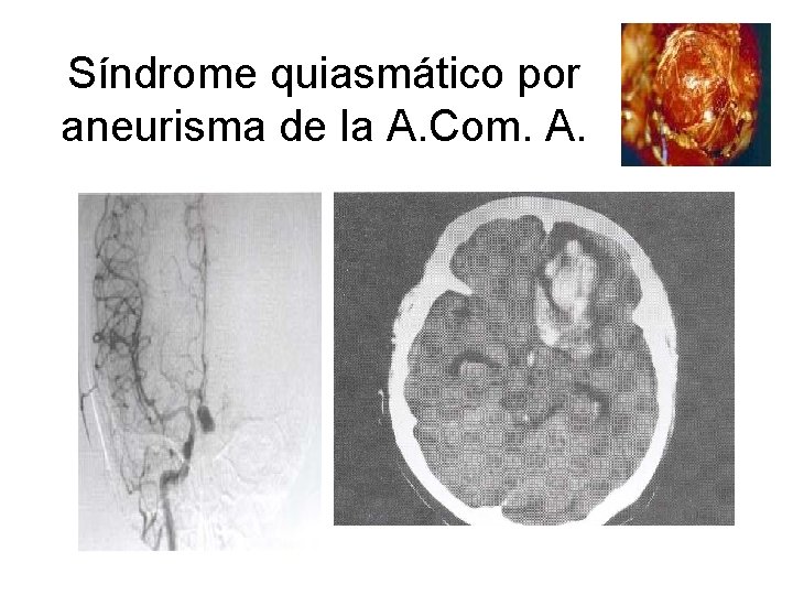 Síndrome quiasmático por aneurisma de la A. Com. A. 