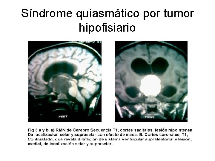 Síndrome quiasmático por tumor hipofisiario 