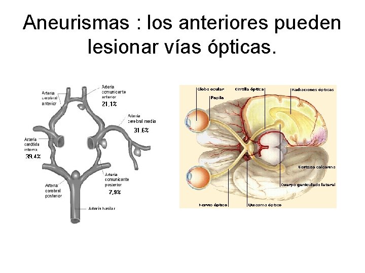 Aneurismas : los anteriores pueden lesionar vías ópticas. 