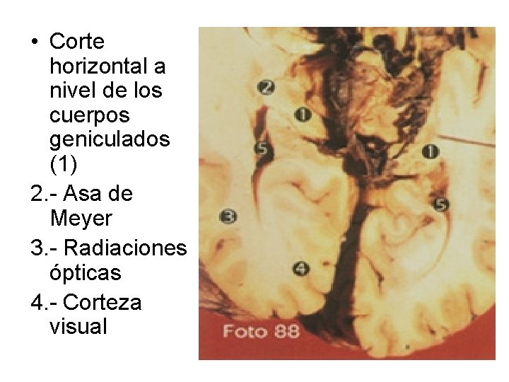  • Corte horizontal a nivel de los cuerpos geniculados (1) 2. - Asa