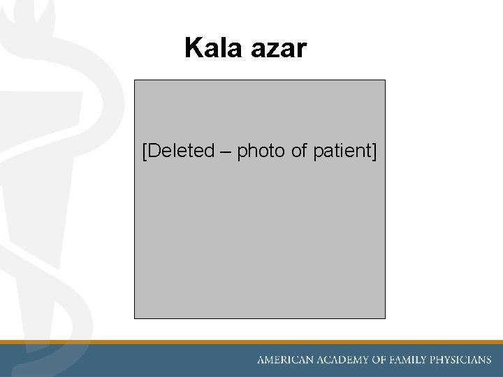 Kala azar [Deleted – photo of patient] 