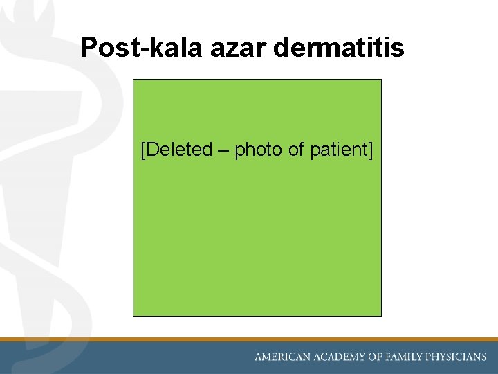 Post-kala azar dermatitis [Deleted – photo of patient] 