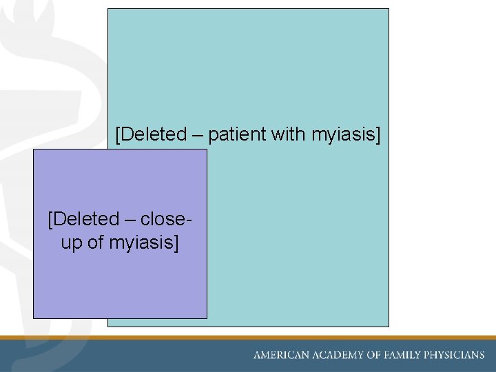 [Deleted – patient with myiasis] [Deleted – closeup of myiasis] 