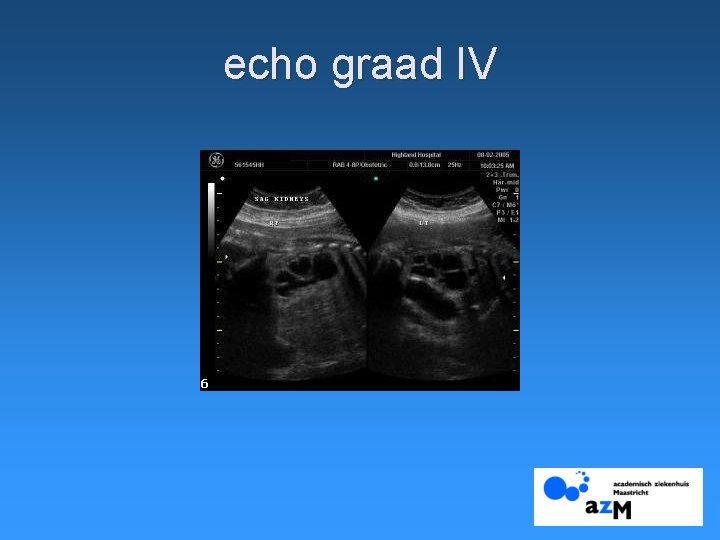 echo graad IV 