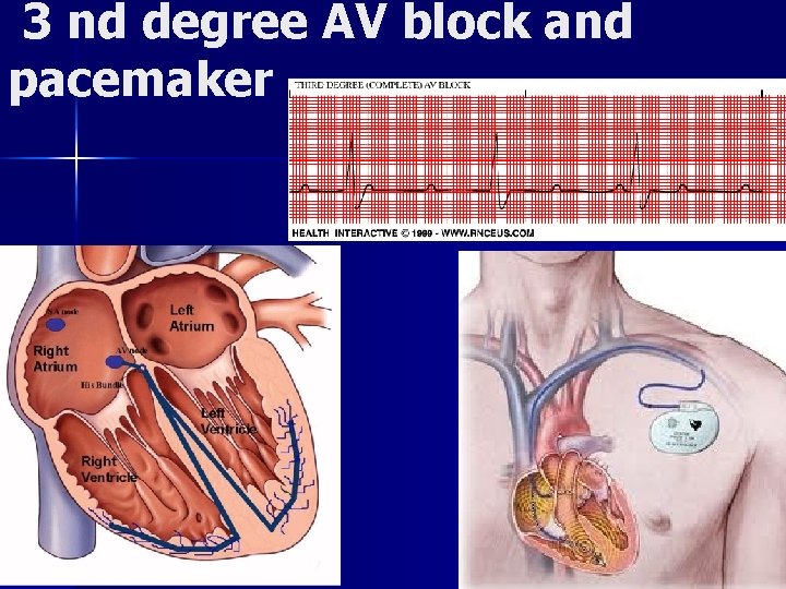 3 nd degree AV block and pacemaker 