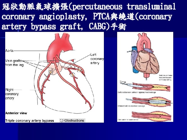 冠狀動脈氣球擴張(percutaneous transluminal coronary angioplasty, PTCA與繞道(coronary artery bypass graft, CABG)手術 