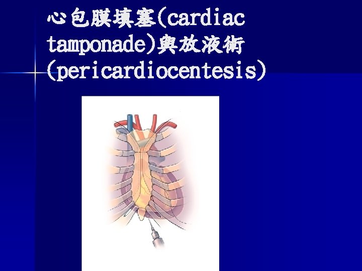 心包膜填塞(cardiac tamponade)與放液術 (pericardiocentesis) 