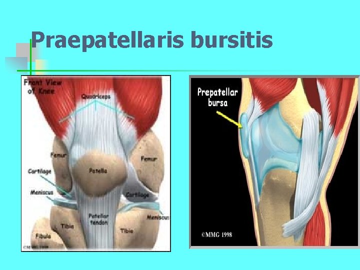 Praepatellaris bursitis 