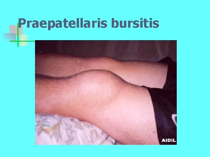 Praepatellaris bursitis 