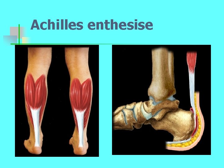 Achilles enthesise 