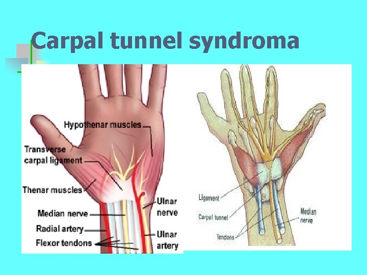 Carpal tunnel syndroma 