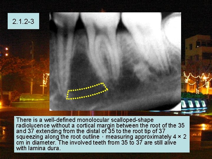 2. 1. 2 -3 There is a well-defined monolocular scalloped-shape radiolucence without a cortical