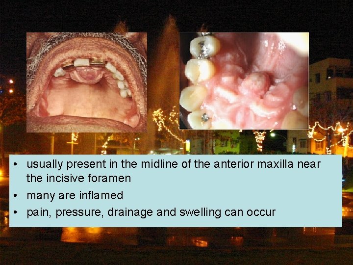  • usually present in the midline of the anterior maxilla near the incisive