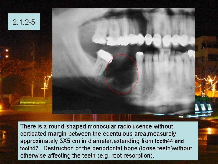 2. 1. 2 -5 There is a round-shaped monocular radiolucence without corticated margin between